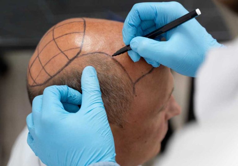 Hair Transplant