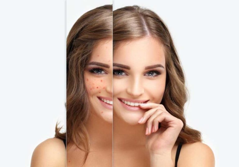Pigmentation