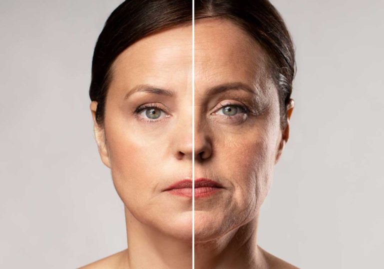 Face Lift