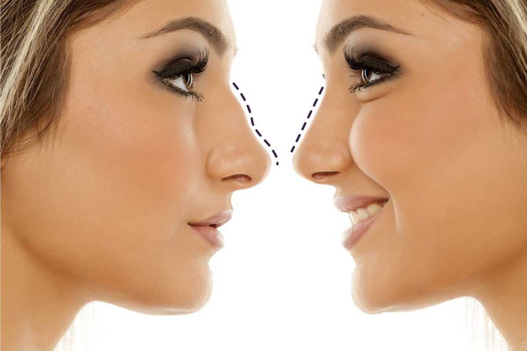 Best Rhinoplasty Surgeon in Lahore