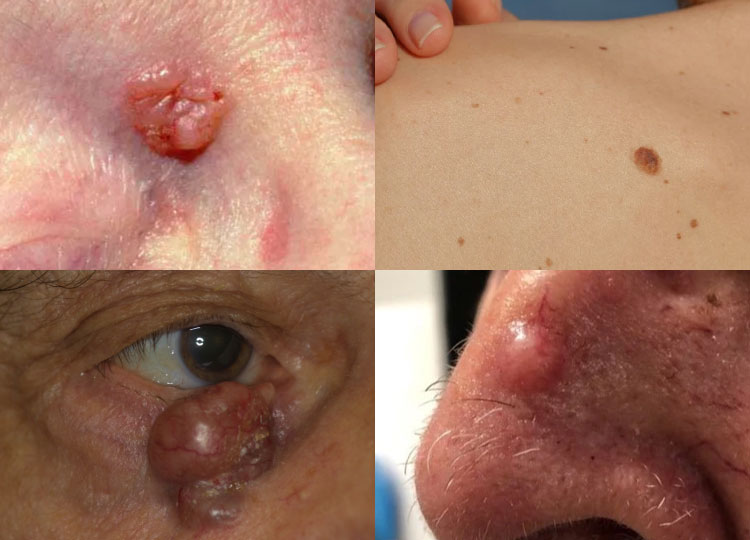 Dr. Amin Alam: Leading Oncology Surgeon for Cancer Recovery Bascal Cell Carcinoma BCC treatment in Lahore Pakistan - oncology surgeon Dr. Amin Alam