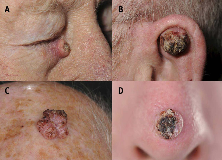 Dr. Amin Alam: Leading Oncology Surgeon for Cancer Recovery Squamous Cell Carcinoma SCC treatment in Lahore Pakistan - oncology surgeon Dr. Amin Alam