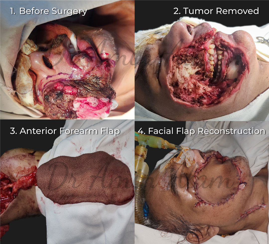 Dr. Amin Alam: Leading Oncology Surgeon for Cancer Recovery Facial Cancer Reconstruction by Dr. Amin Alam