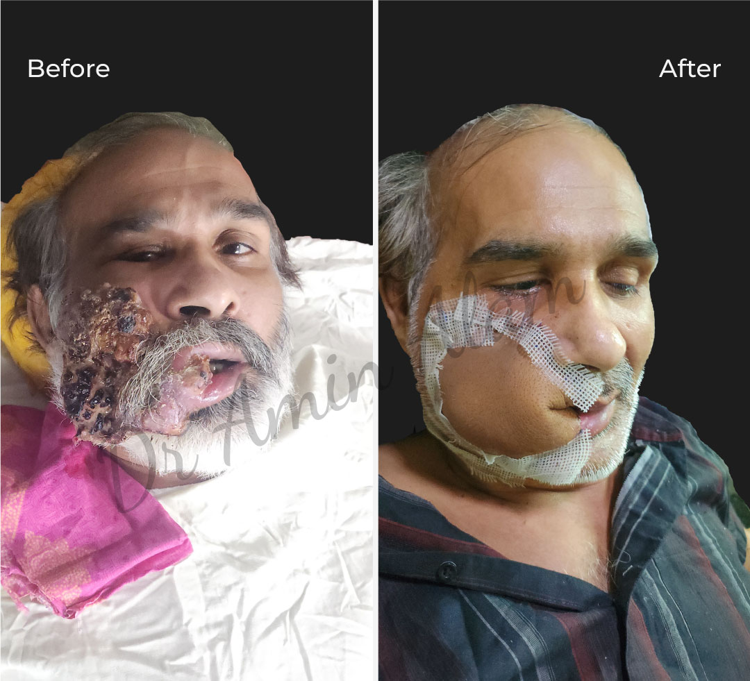 Dr. Amin Alam: Leading Oncology Surgeon for Cancer Recovery Facial Cancer Reconstruction by Dr. Amin Alam
