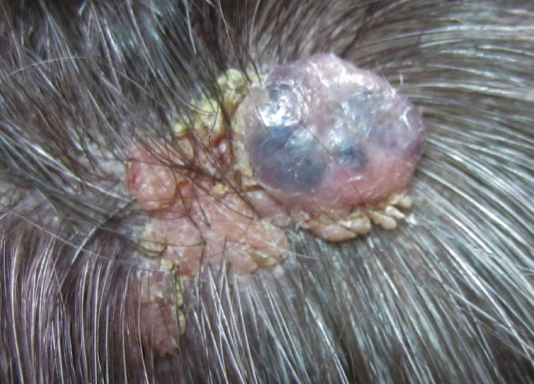 Dr. Amin Alam: Leading Oncology Surgeon for Cancer Recovery scalp cancer treatment in Lahore Pakistan - oncology surgeon Dr. Amin Alam
