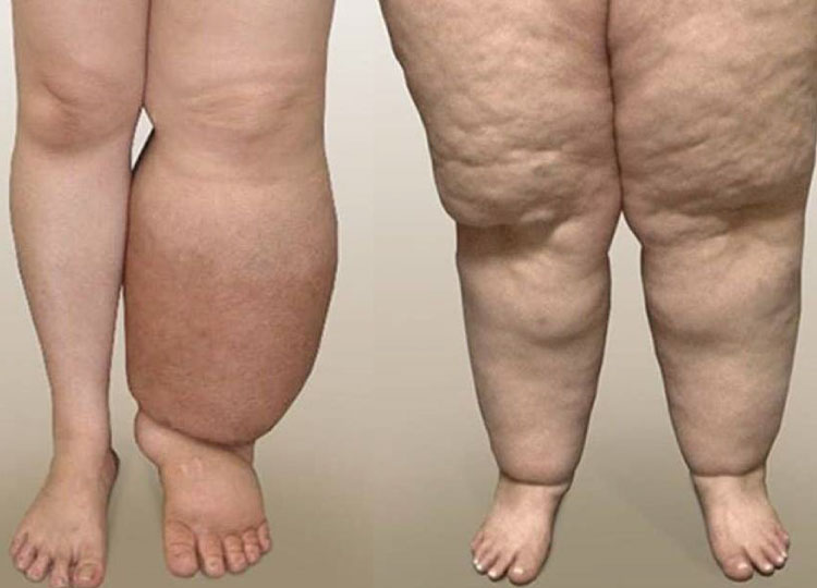 Dr. Amin Alam: Leading Oncology Surgeon for Cancer Recovery Swollen body mass treatment in Lahore Dr. Amin Alam Oncology Surgeon