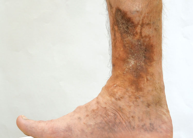 Dr. Amin Alam: Leading Oncology Surgeon for Cancer Recovery Non healing Leg Ulcers treatment in Lahore Pakistan - oncology surgeon Dr. Amin Alam