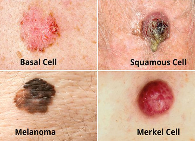 Dr. Amin Alam: Leading Oncology Surgeon for Cancer Recovery Skin Cancer treatment in Lahore Pakistan - oncology surgeon Dr. Amin Alam
