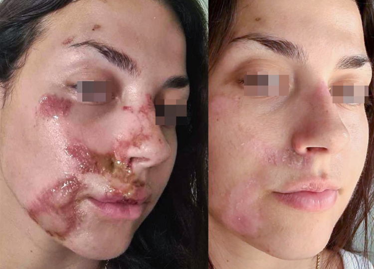 Burn Reconstruction Surgery Facial Burn Reconstruction