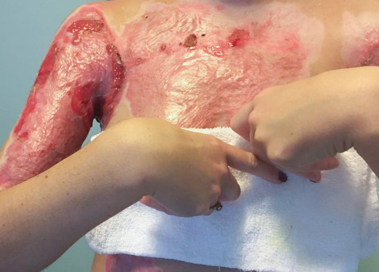 Burn Reconstruction Surgery