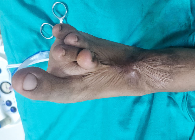Burn Reconstruction Surgery
