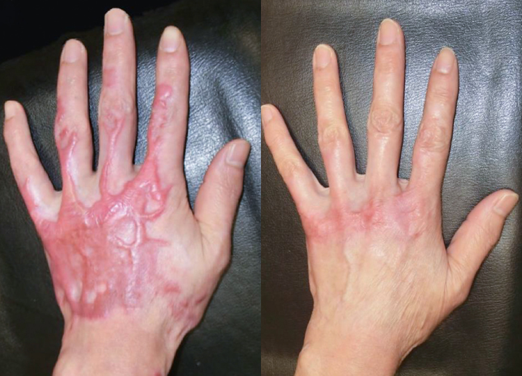Burn Reconstruction Surgery Hand and Extremity Reconstruction