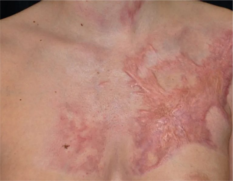 Burn Reconstruction Surgery Burn Scar reconstruction Treatment by Dr. Amin Alam