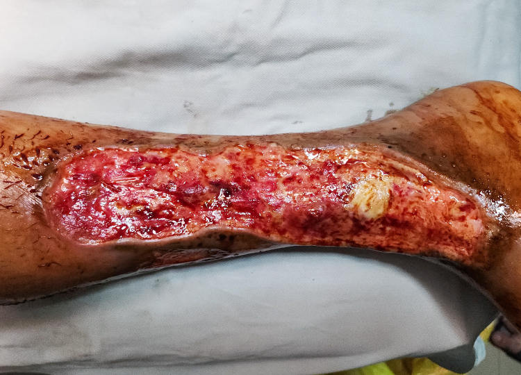 Burn Reconstruction Surgery