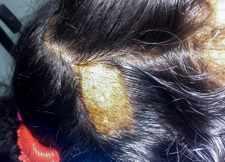 Burn Reconstruction Surgery Hair Burn Transplant Surgery Performed by Dr Amin Alam the Best Plastic Surgeon in Lahore, Pakistan