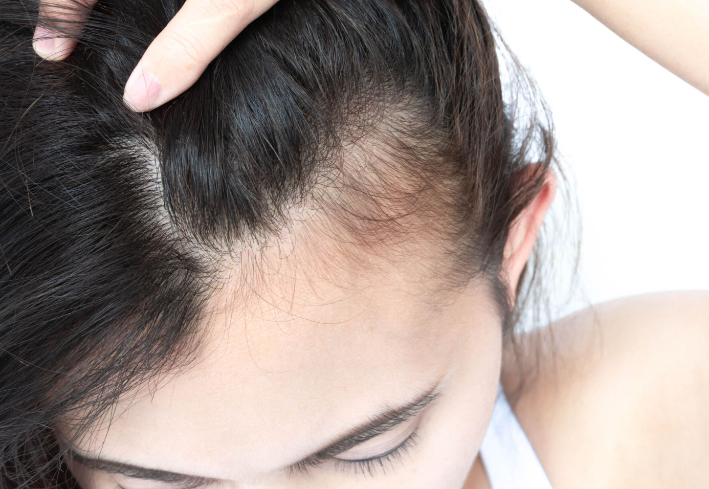 Hair Transplant Services by Dr. Amin Alam – Restore Your Confidence Traction Alopecia treatment in lahore by dr. amin alam
