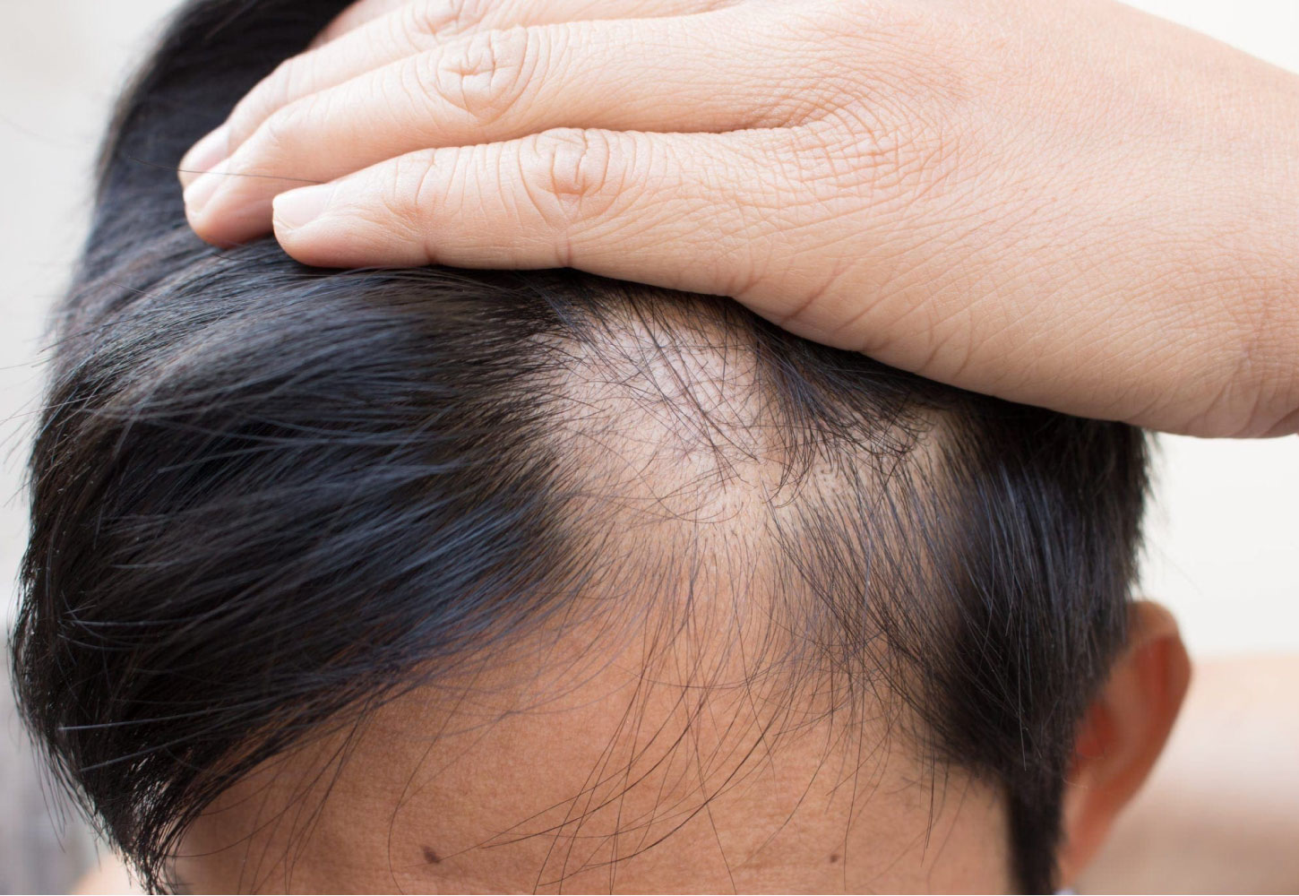 Hair Transplant Services by Dr. Amin Alam – Restore Your Confidence Alopecia Areata (Patchy) Treatment in Pakistan by Dr. Amin Alam