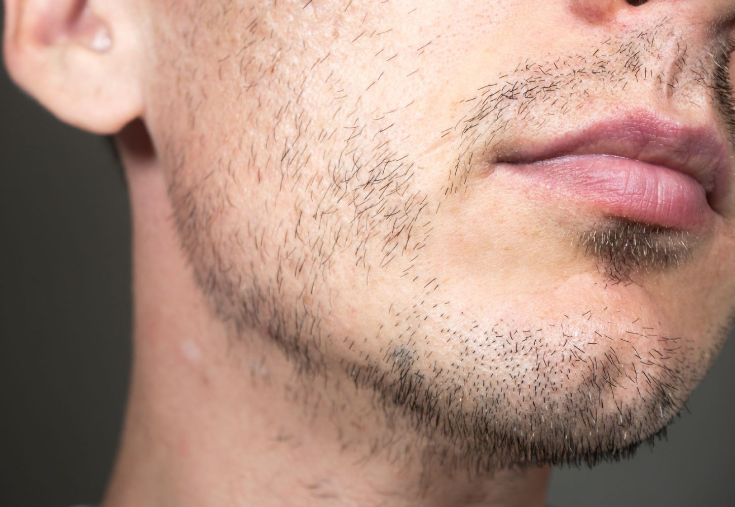 Hair Transplant Services by Dr. Amin Alam – Restore Your Confidence patchy or thin hair beard treatment in Pakistan