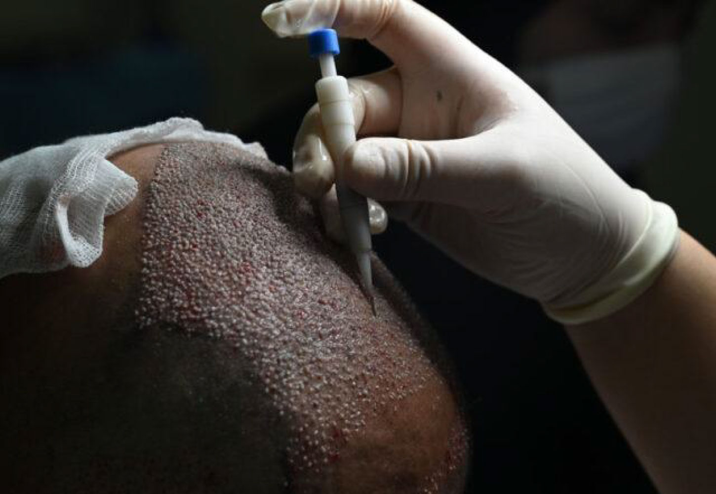 Hair Transplant Services by Dr. Amin Alam – Restore Your Confidence DHI Turkey Hair Transplant in Pakistan by Dr Amin Alam
