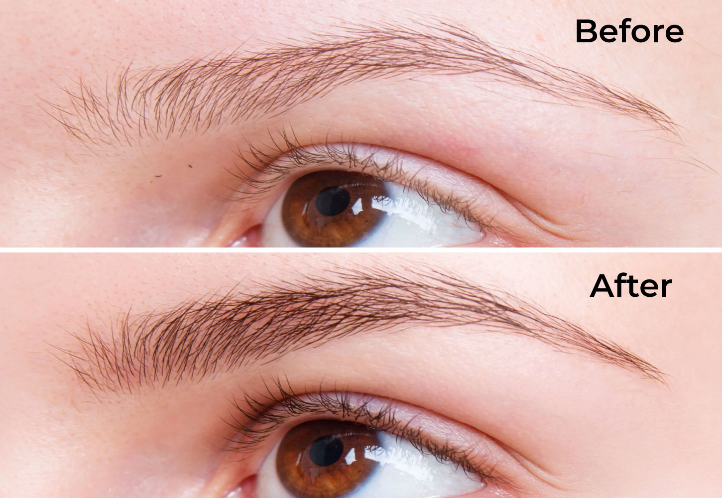 Hair Transplant Services by Dr. Amin Alam – Restore Your Confidence Eyebrows Transplant