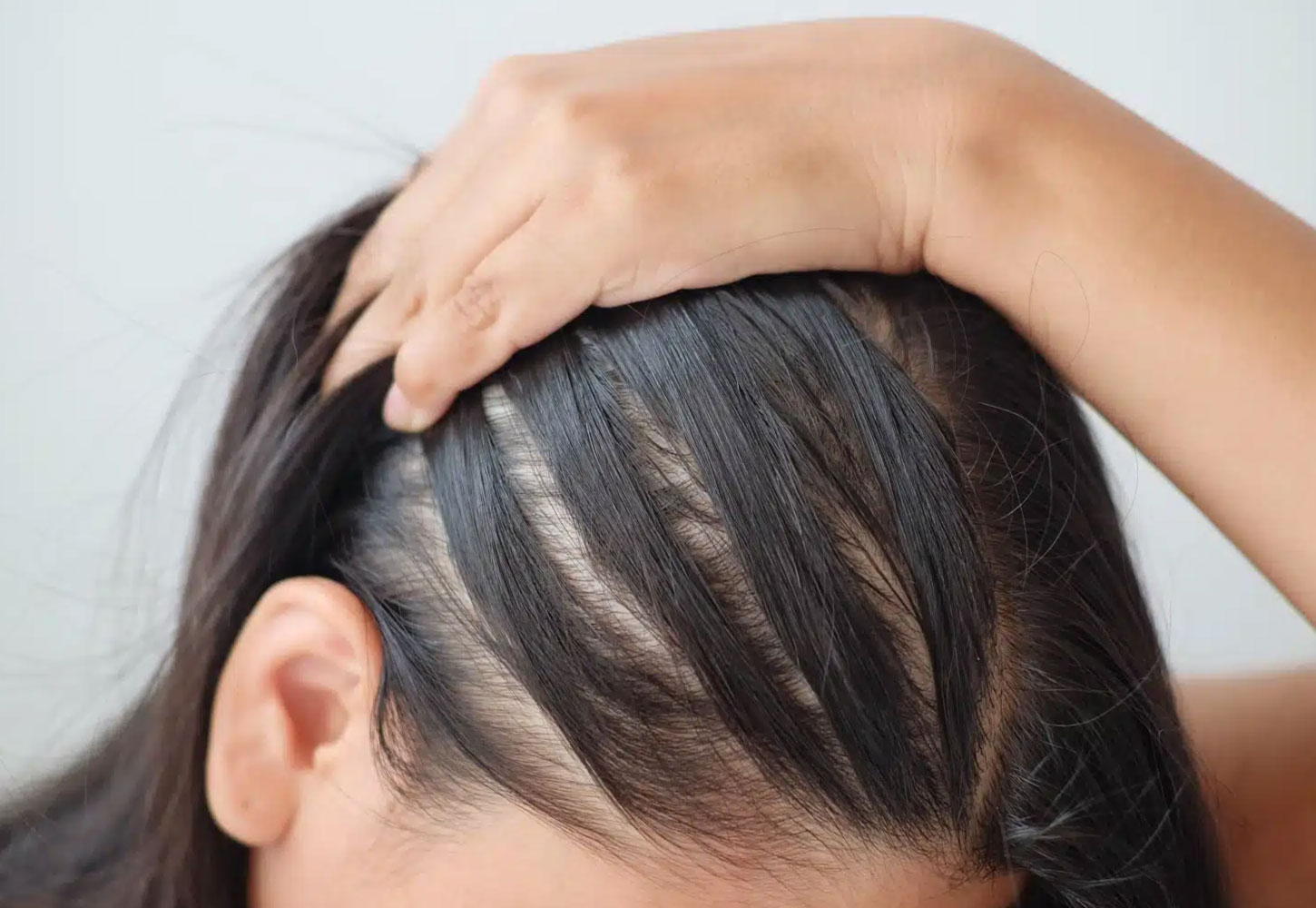 Hair Transplant Services by Dr. Amin Alam – Restore Your Confidence women hair thinning treatment by Dr. amin alam