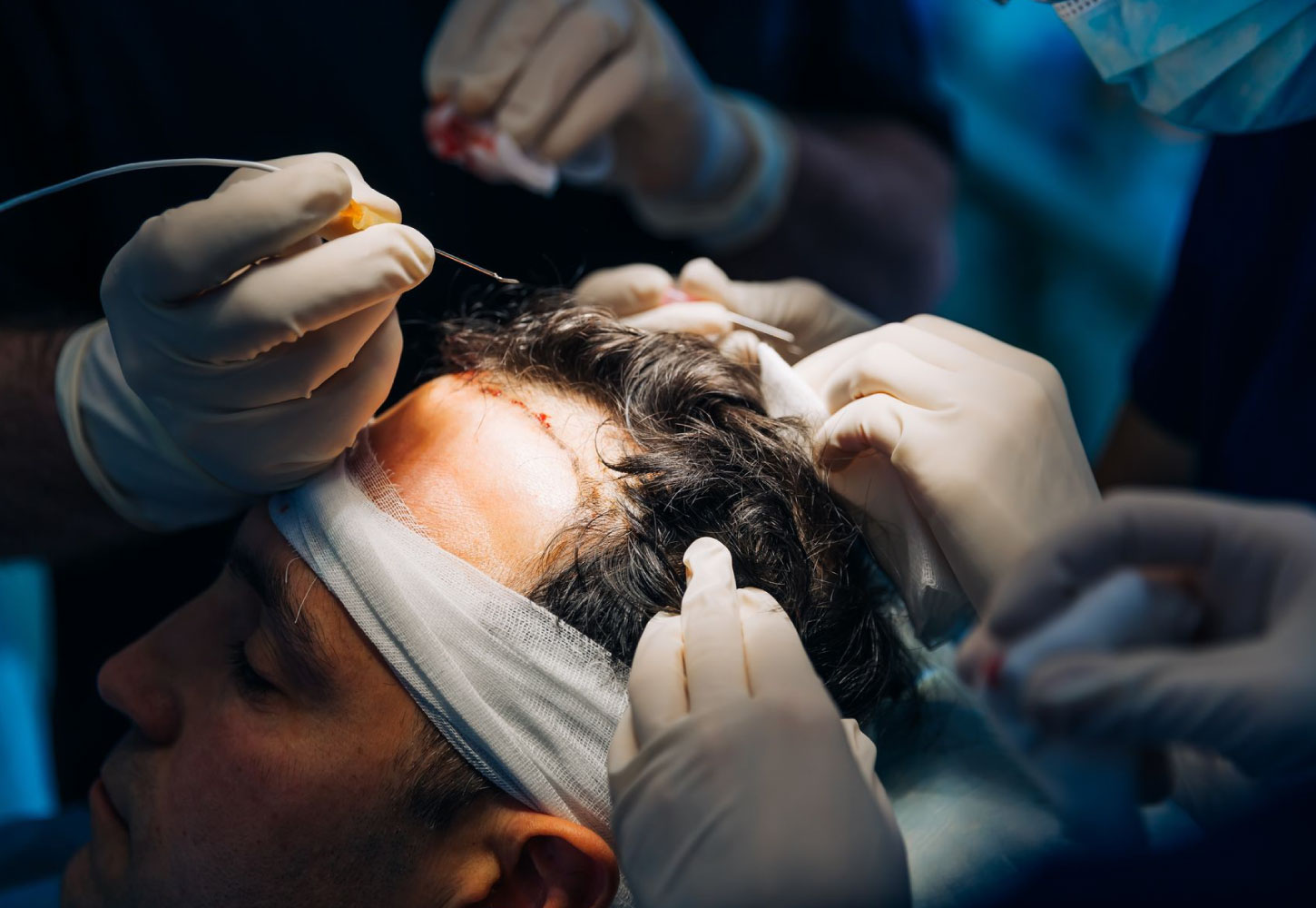 Hair Transplant Services by Dr. Amin Alam – Restore Your Confidence FUE FUT HYBRID Hair Transplant in Pakistan by Dr Amin Alam