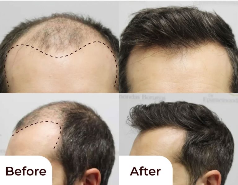Hair Transplant Services by Dr. Amin Alam – Restore Your Confidence Hair transplant results
