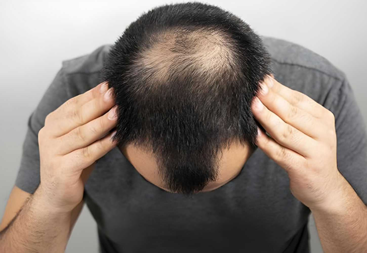 Hair Transplant Services by Dr. Amin Alam – Restore Your Confidence Male Pattern Baldness treatment in Pakistan by dr. amin alam