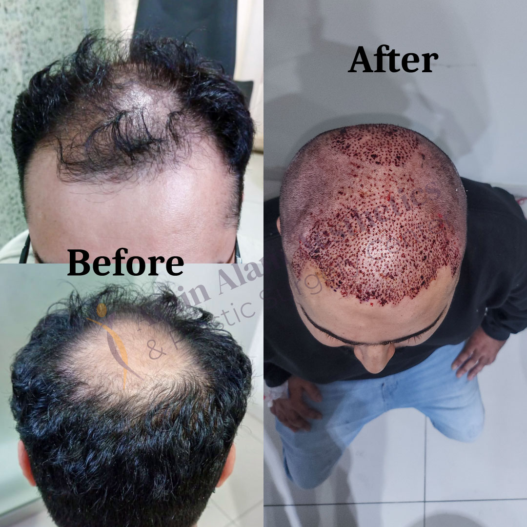Hair Transplant Services by Dr. Amin Alam – Restore Your Confidence Hair Transformation before after. Hair Transplant done by Dr. Amin Alam Plastic Surgeon Lahore