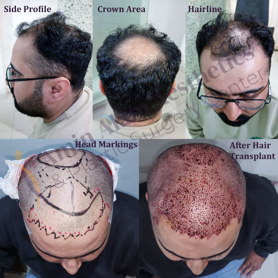 Hair Transplant Services by Dr. Amin Alam – Restore Your Confidence Hair Transformation Journey. Hair Transplant done by Dr. Amin Alam Plastic Surgeon Lahore