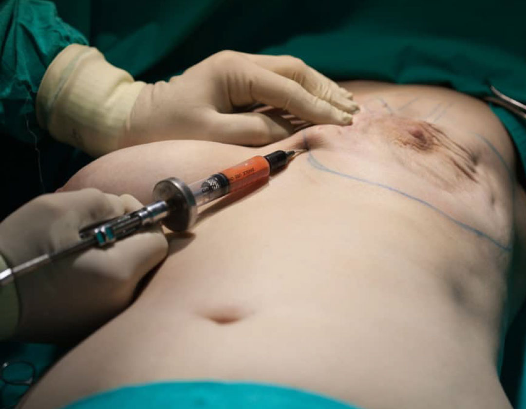 Breast Augmentation with Fat Transfer - Dr. Amin Alam Plastic Surgeon Lahore