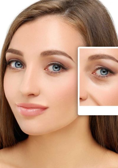 Blepharoplasty Blepharoplasty