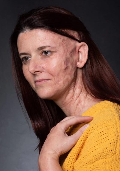 Burn Scar Reconstruction