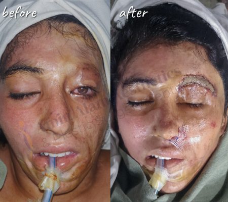 Eye ectropion release surgery performed by Dr. Amin Alam the best plastic surgeon in lahore, Pakistan Eye ectropion release surgery performed by Dr. Amin Alam the best plastic surgeon in lahore, Pakistan