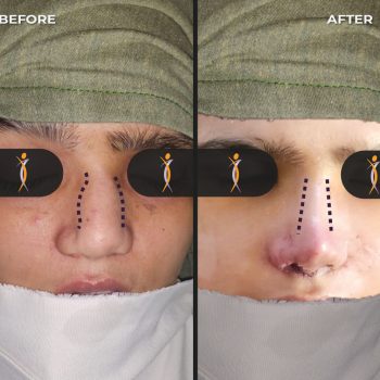 Rhinoplasty-Patient-1-by- Dr Amin Alam Best Rhinoplasty Surgeon in lahore