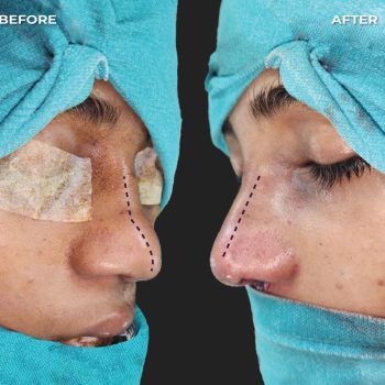 Rhinoplasty-Patient-2-by-Dr Amin Alam Best Rhinoplasty Surgeon in lahore
