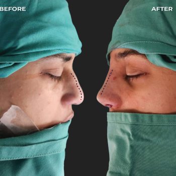 Rhinoplasty-Patient-3-by-Dr Amin Alam Best Rhinoplasty Surgeon in lahore