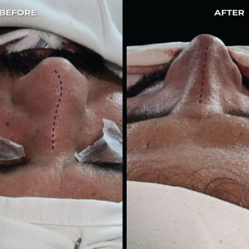 Rhinoplasty-Patient-4-by-Dr Amin Alam Best Rhinoplasty Surgeon in lahore