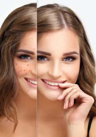 Pigmentation