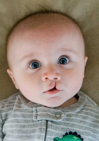cleft-lip