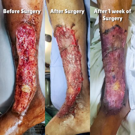 Acid Burn Surgery By Dr. Amin Alam the Best Plastic Surgeon in Lahore, Pakistan. Acid Burn Surgery By Dr. Amin Alam the Best Plastic Surgeon in Lahore, Pakistan.