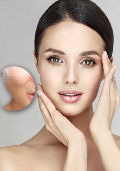 Pore Reduction