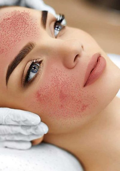 vampire-facial